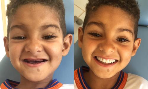 Guajeru: Dentista realiza sonho de menino de ter dentes iguais aos dos colegas