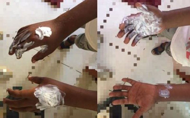 Bahia: Mãe queima as mãos do filho de 8 anos por ele gastar R$ 5 reais sem autorização