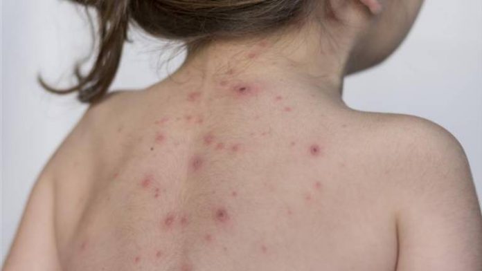 Foto mostra costas de uma menina com manchas provocadas pelo sarampo
