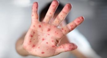 Vigilância Epidemiológica de Vitória da Conquista mantem alerta sobre casos de sarampo