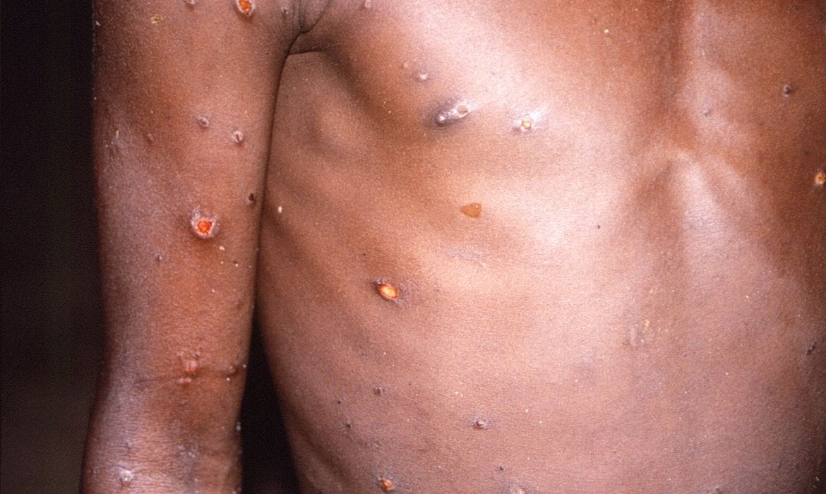 Casos de varíola dos macacos serão monitorizados pelo Ministério da Saúde