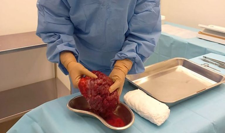 Pesquisadores desenvolvem curativos biológicos à base de placenta