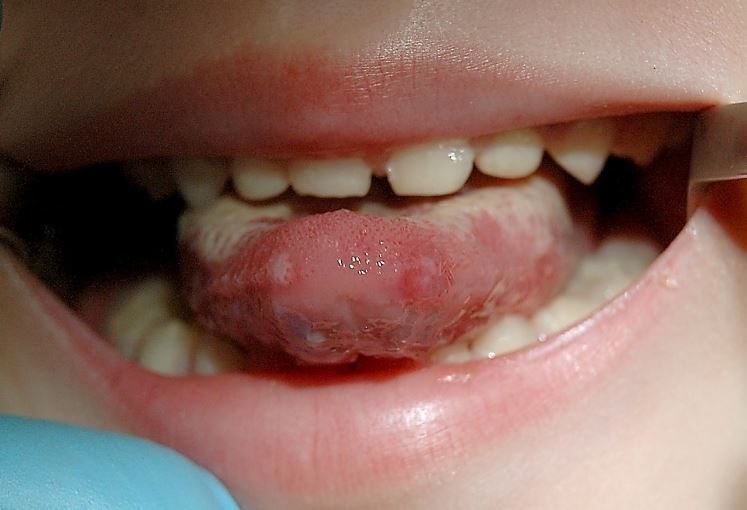 Pesquisadores baianos identificam plantas que podem tratar candidíase oral