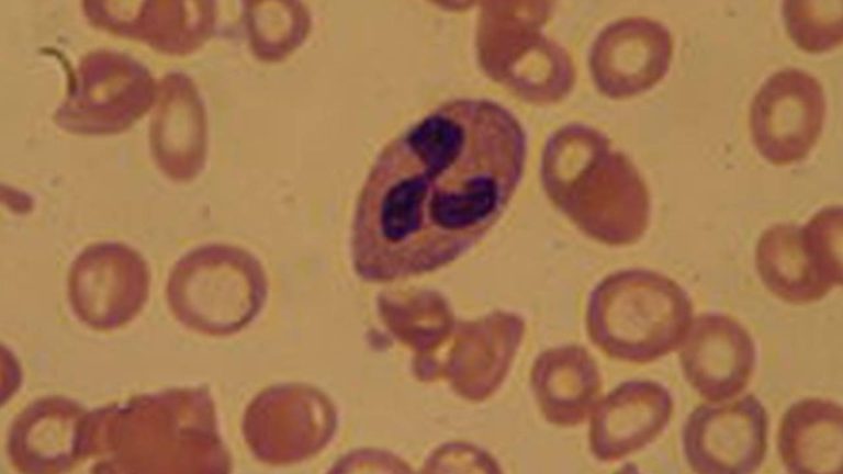 anemia