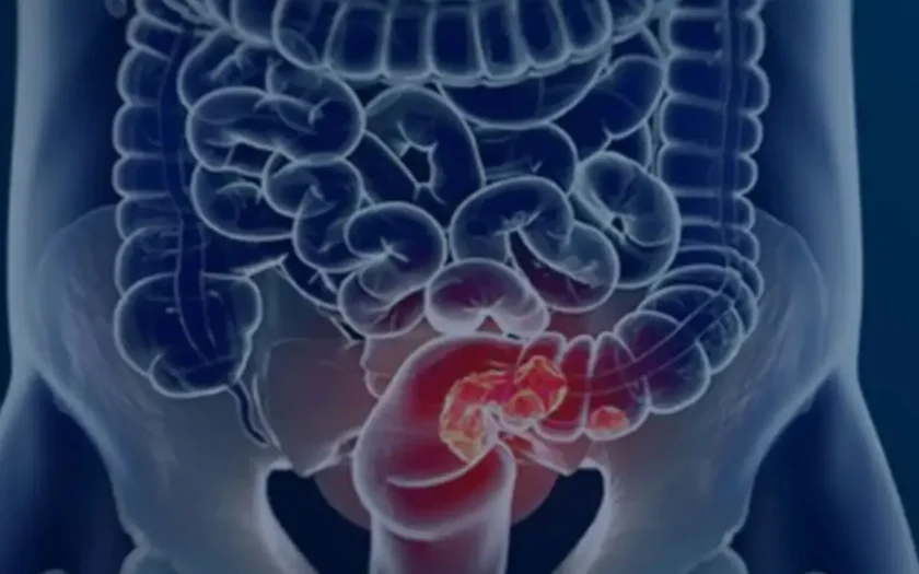 Teste Imunoquímico Fecal