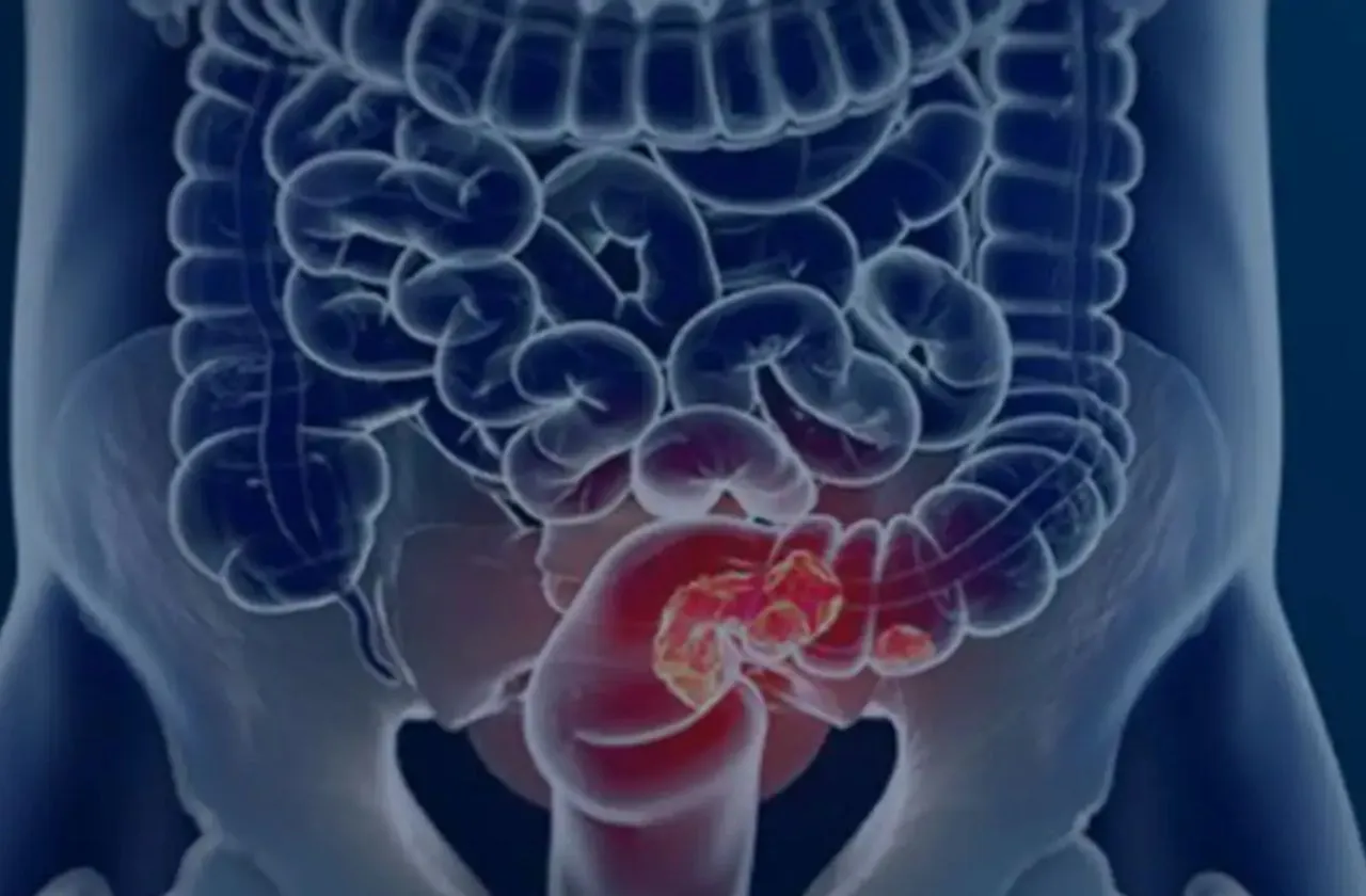 SUS irá implementar teste fecal para detecção precoce do câncer colorretal
